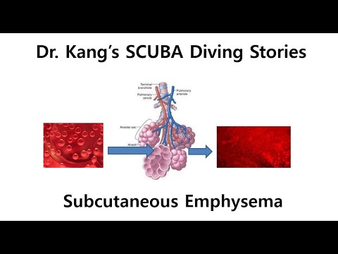 Dr.Kang's SCUBA Diving Stories - Postdive Subcutaneous Emphysema - YouTube