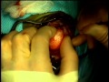 Craniectomy for anterior fontanel skull lesion with ...