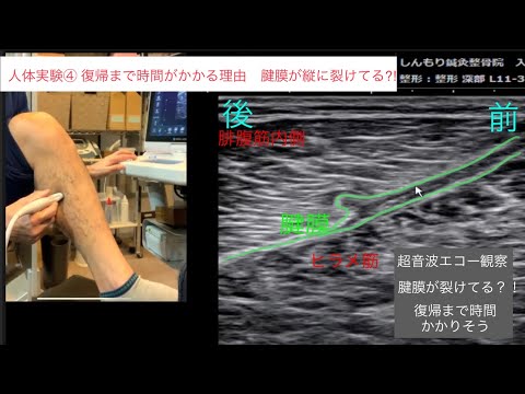 【人体実験④】ふくらはぎ肉離れエコー　縦に裂ける