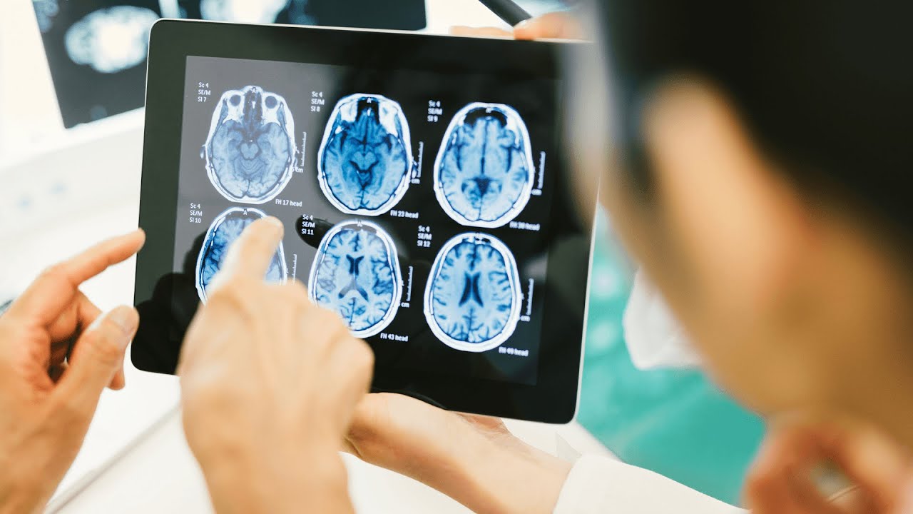 Top 8 Superfoods for Brain Health