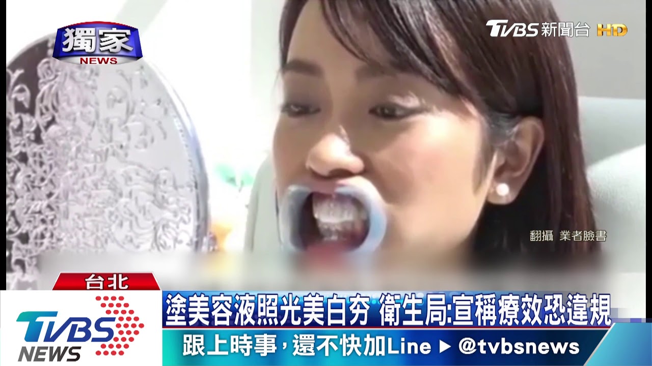 坊間多「樹脂貼片」美白齒　不貼齒型恐蛀牙