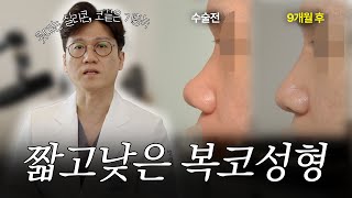 콧대와 코끝 개선으로 ‘오목한 얼굴’ 탈출! | 남자 코성형 9개월 경과 케이스리뷰 (기증 늑연골 + 실리콘)