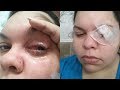 girl loses eye watching solar eclipse..