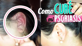 COMO CURÉ MI PSORIASIS - Euzema Confidence Revival Cream Review