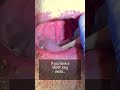 Long Uvula And Snoring Shorts Fauquierent