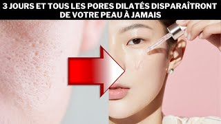 3 jours et tous les pores dilatés disparaîtront de votre peau à jamais