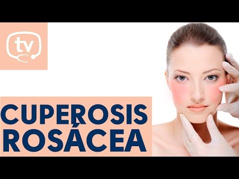 La cuperosis o rosácea
