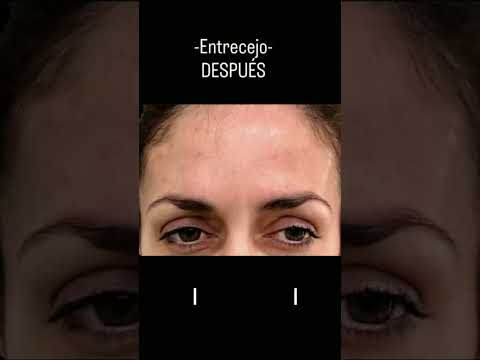 Botox ahora en Balnearia provincia de Córdoba 2975295020 www.onbeauty.ar