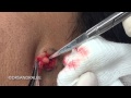 Cyst excision and a shave removal on a young man's face. For medical education- NSFE.