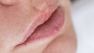 how to get rid of hives on your lips