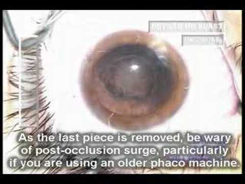 Posterior Subcapsular Cataract (PSC) Surgery - Phaco Soft Technique