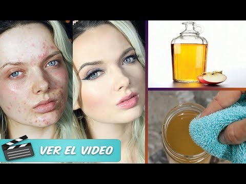 vinagre de manzana y bicarbonato para la cara