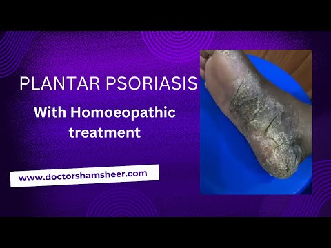 Plantar psoriasis