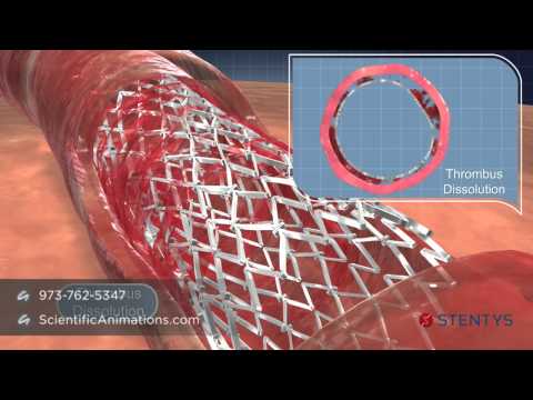 3D Medical Animation of Coronary Stent Procedure