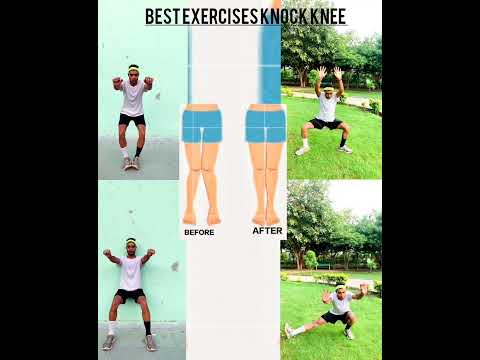 BEST EXERCISES FOR KNOCK KNEE/ Bow leg exercise/100% Resolve#fitness#viral #workout#trending#shorts