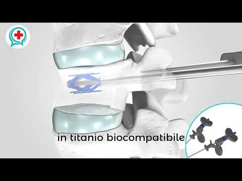 Mobilità spalla Corsetto overlay nella patologia del rachide cervicale