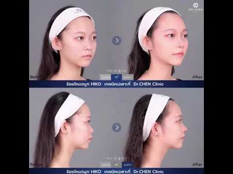 จะร้อยไหม จมูก หรือ เสริมจมูกไปเลยดี ? คลิปนี้ มีคำตอบ !! จะร้อยไหม จมูก หรือ เสริมจมูกไปเลยดี ? คลิปนี้ มีคำตอบ !!