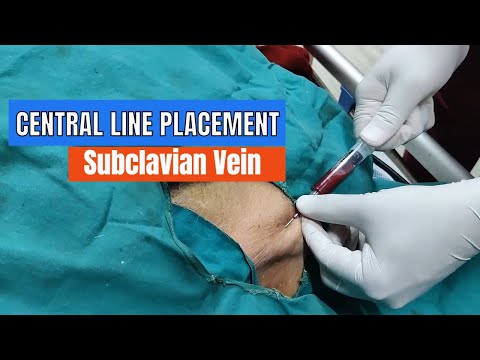 Central Line placement: Subclavian Vein Approach