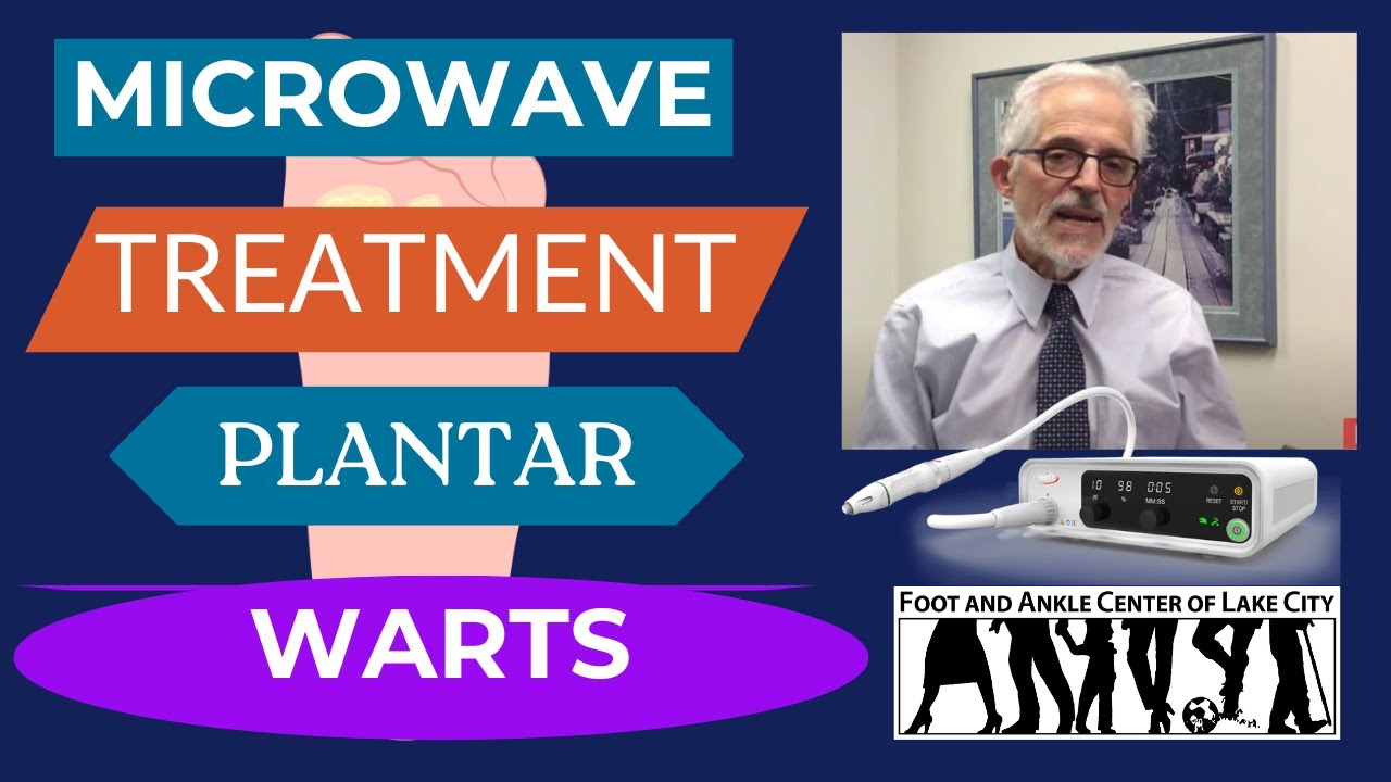 Swift Microwave Treatment for Plantar Warts Foot and Ankle Center of