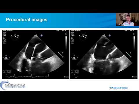 CVI - Transcatheter Mitral Innovations