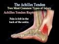 Achilles Tendon rupture ,tear, tendonitis - Everything ...