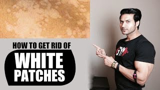 How to Get Rid of WHITE PATCHES (सफेद दाग) on Skin | Remedies by Guru Mann