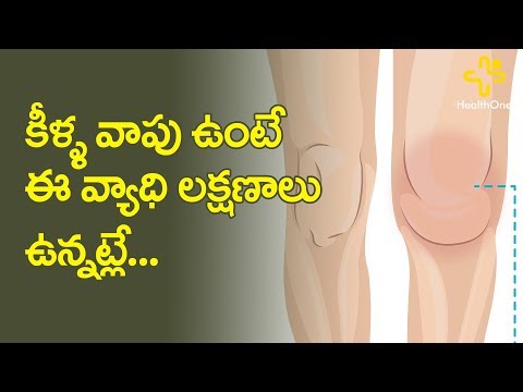 Rheumatoid Arthritis Symptoms And Treatment | Dr Sarath Chandra Mouli Veeravalli | TeluguOne Health