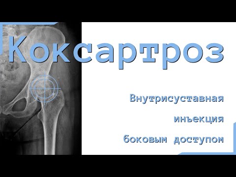 Продлеваем жизнь суставу: Внутрисуставное введение гиалуроновой кислоты в тазобедренный сустав