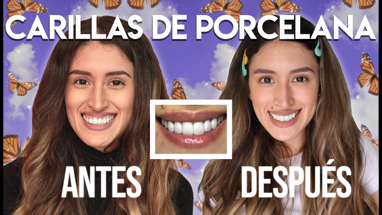 Carillas Dentales de Porcelana: Antes y Después (Mi Experiencia, Paso a Paso y Más!)