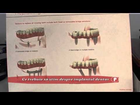 (P) Ce trebuie să ştim despre implantul dentar