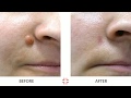 Warts மரு 3 நாட்களில் மறையும் Science Journal Proof Warts Remo