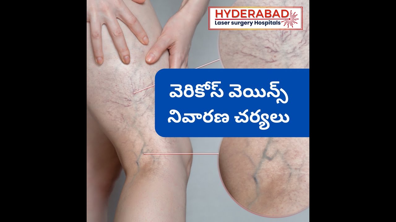 Varicose Veins Video 2