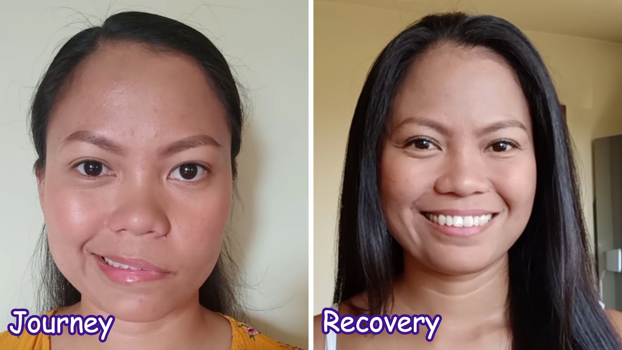 My Bell's Palsy journey to recovery | Facial Paralysis