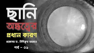 চোখের ছানি | Cataract | Dr. S. Rahman | Glaucoma & Refractive Surgeon