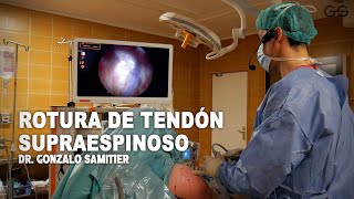 HOMBRO CONGELADO - CAPSULITIS ADHESIVA (Adhesive capsulitis) + REPARACIÓN DE MANGUITO ROTADOR