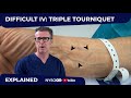 Difficult Intravenous (IV) cannulation #2: Triple Tourniquet Technique