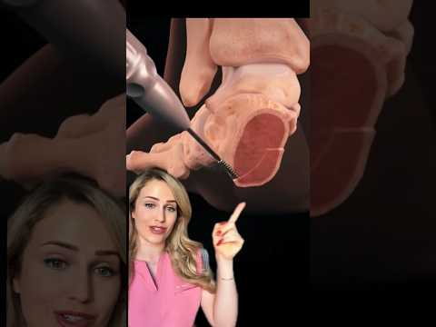 Doctor explains flatfoot surgery animation