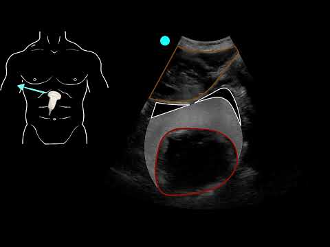 POCUS - Positive EFAST exam with hemopericardium