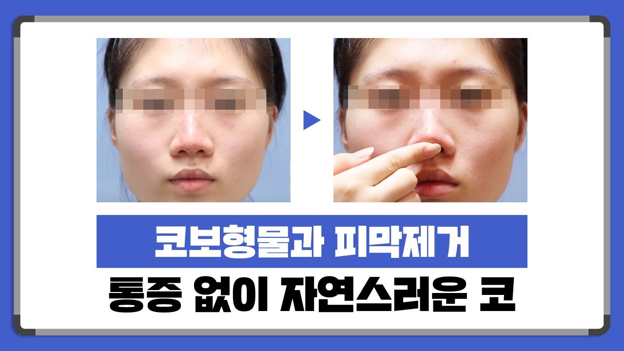 다양한 코 실리콘 부작용 해결 사례 썸네일