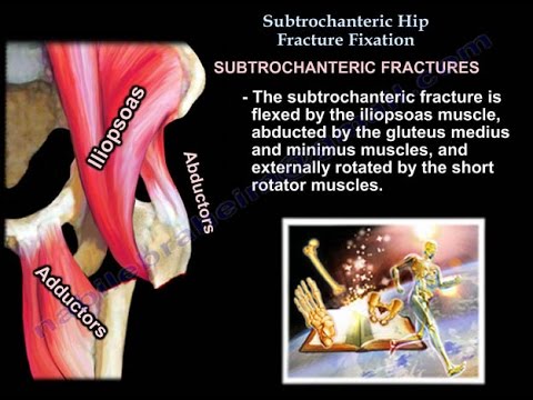 Femur fracture ,Subtrochanteric fracture - Everything You Need To Know - Dr. Nabil Ebraheim