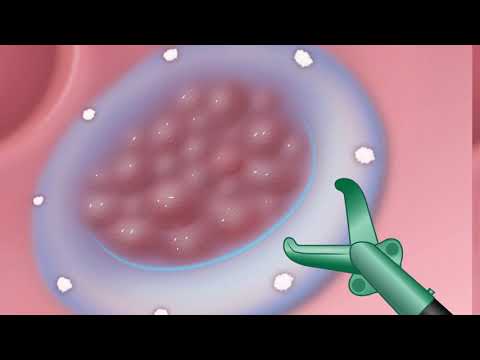 Colonoscopy: Hybrid EMR Steps Graphic Illustration