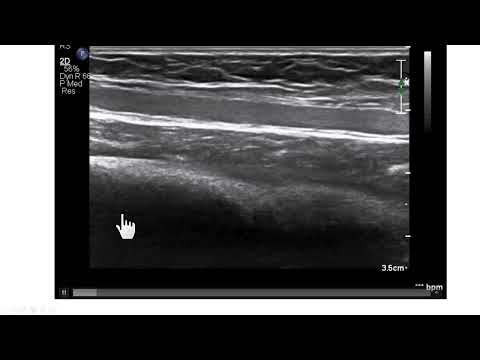 Inserção de cateter central por veia periférica guiada pela ultrassonografia