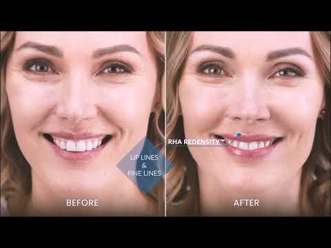 ✨ Natural, Flexible Fillers! RHA Explained: Lips, Cheeks, Jawline & More! 👄💉