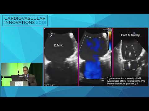 CVI2018 Session: Is transcatheter therapy innovation necessary? - David Rizik, MD