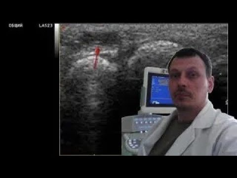Pediatric MSK (Soft tissue) ultrasound - Tendon's cyst