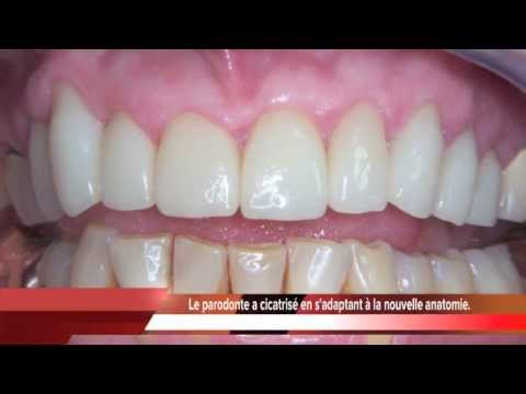 comment traiter fistule dentaire