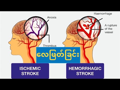 လေဖြတ်ခြင်း Stroke ဆိုသည်မှာ ... Understanding Stroke | Medical Insights on Stroke