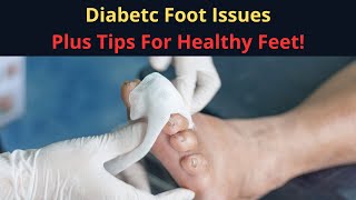 How Diabetes Affects Your Feet (Diabetic Foot) - Identifying Diabetic Foot Symptoms