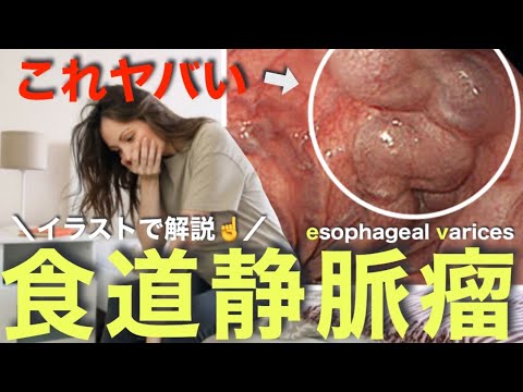 食道静脈瘤 - 定義