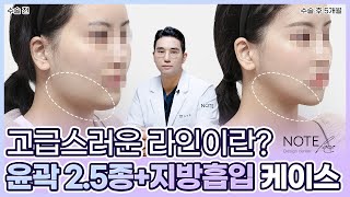 [유.케.리] CT로 보는 케이스 리뷰 l 옆 턱 라인의 중요성 l 여성스럽고 고급스러운 윤곽 라인 l 광대 축소 + 핀리스 브이라인 l